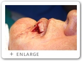Right Lower Lip Skin Cancer