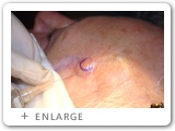 Left Temple Basal Cell Cancer