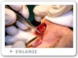Left Nasal Rim Skin Cancer