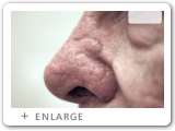 Left Nasal Rim Skin Cancer
