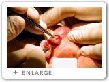 Left Nasal Rim Skin Cancer